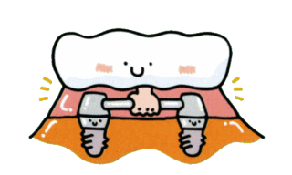 インプラント治療：歯が全部抜けた場合