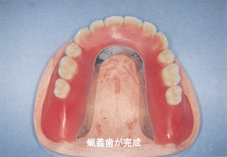 (4)蝋義歯が完成