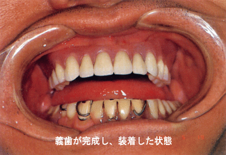 (5)義歯が完成し、装着した状態