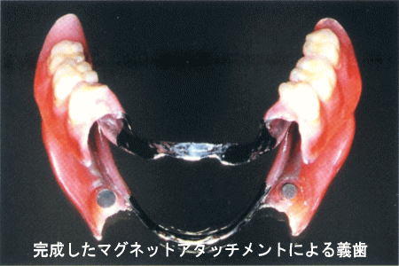 (3)完成したマグネットアタッチメントによる義歯